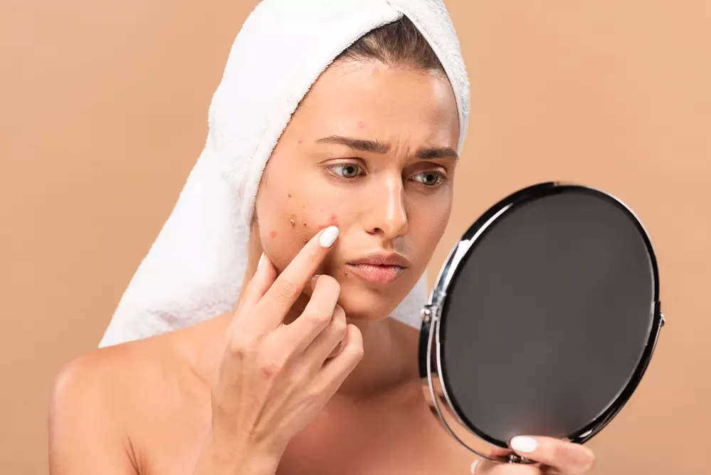 Behandeling van acne: dit doe je tegen die vervelende pukkels